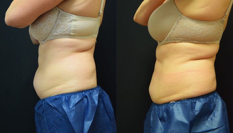 Body Contouring With Coolsculpting